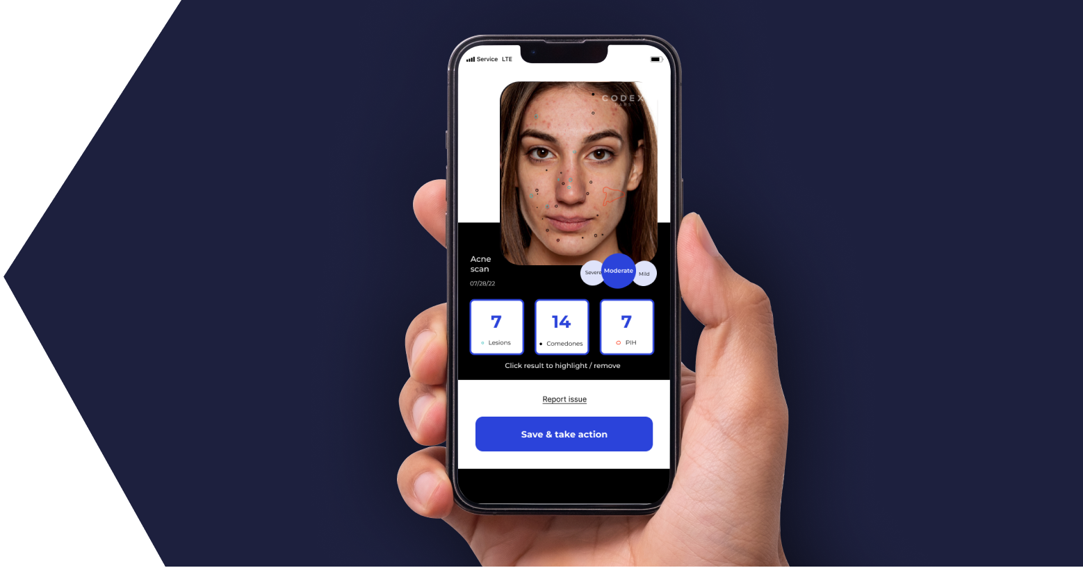 A hand holding a cell phone displaying the Dermscore app.