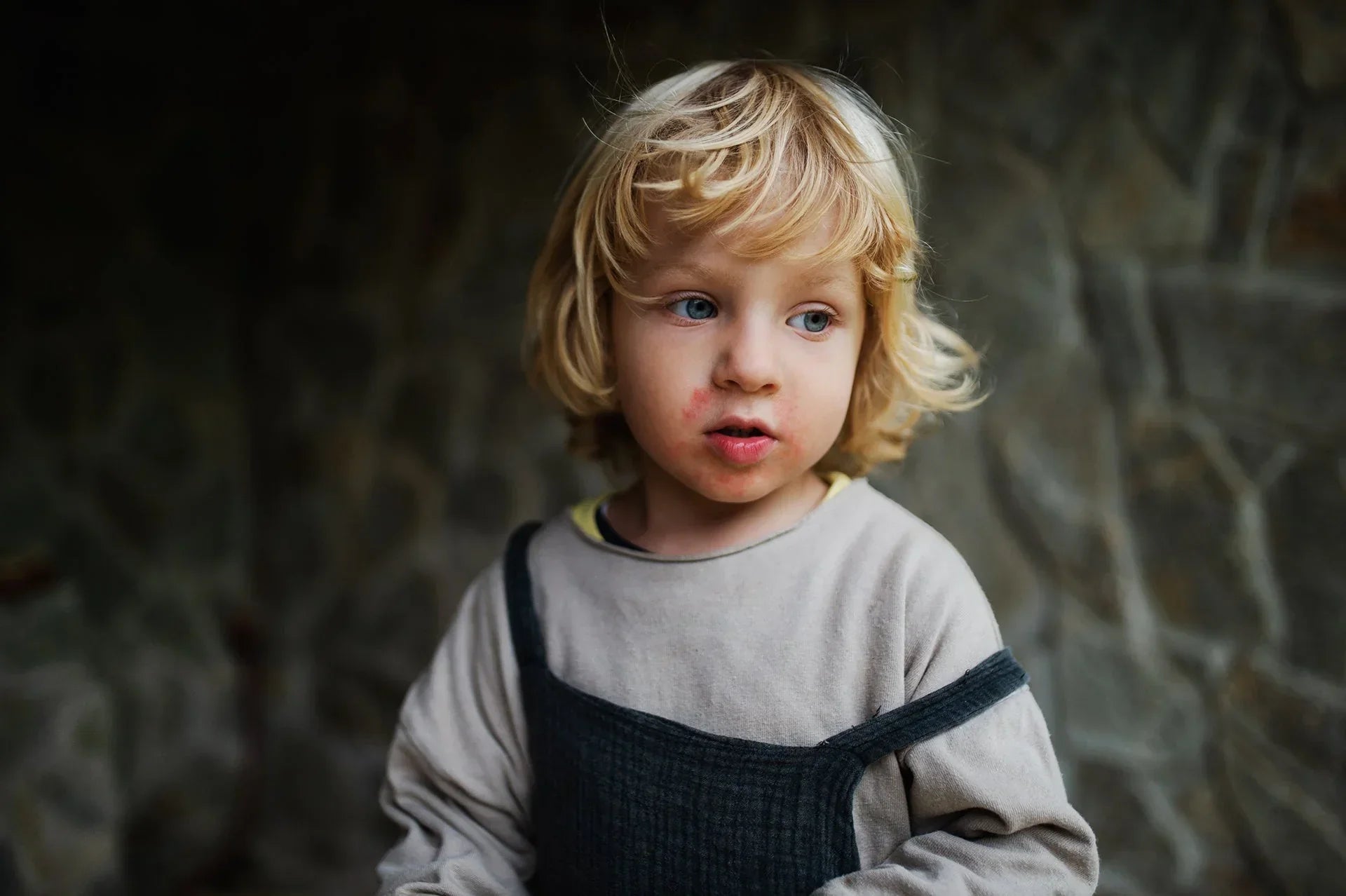 Boy with eczema near his liips