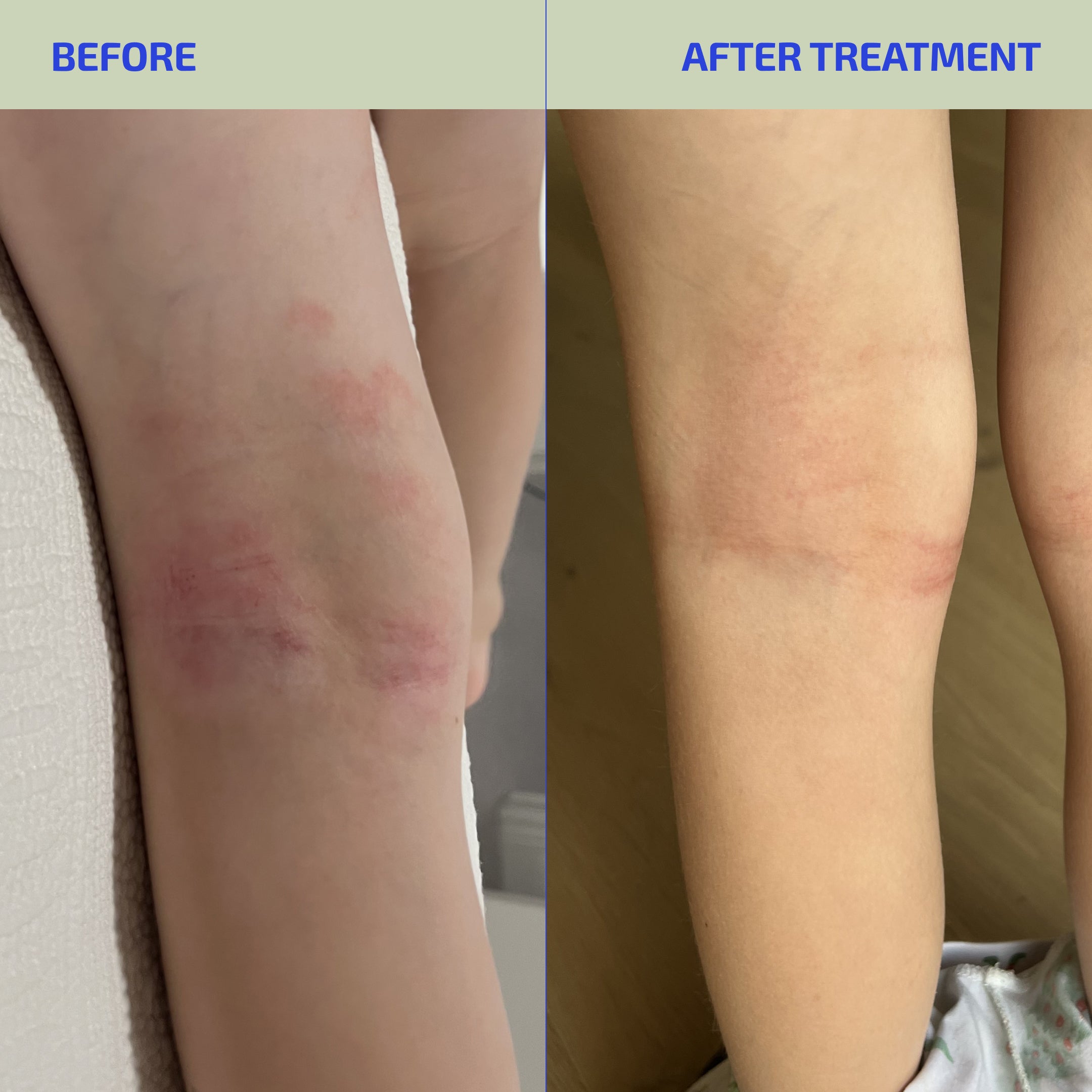 Skin Barrier Ultra Hydrating Relief System (Kids: 4-12)
