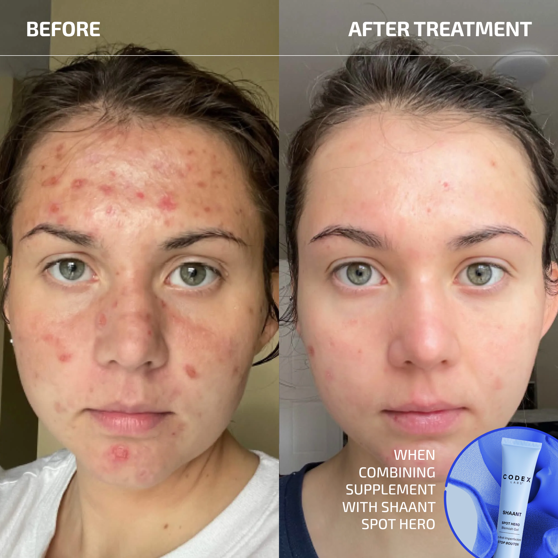 Acne Probiotic Supplement for Clear Skin – SHAANT 2.0 (60 Capsules)